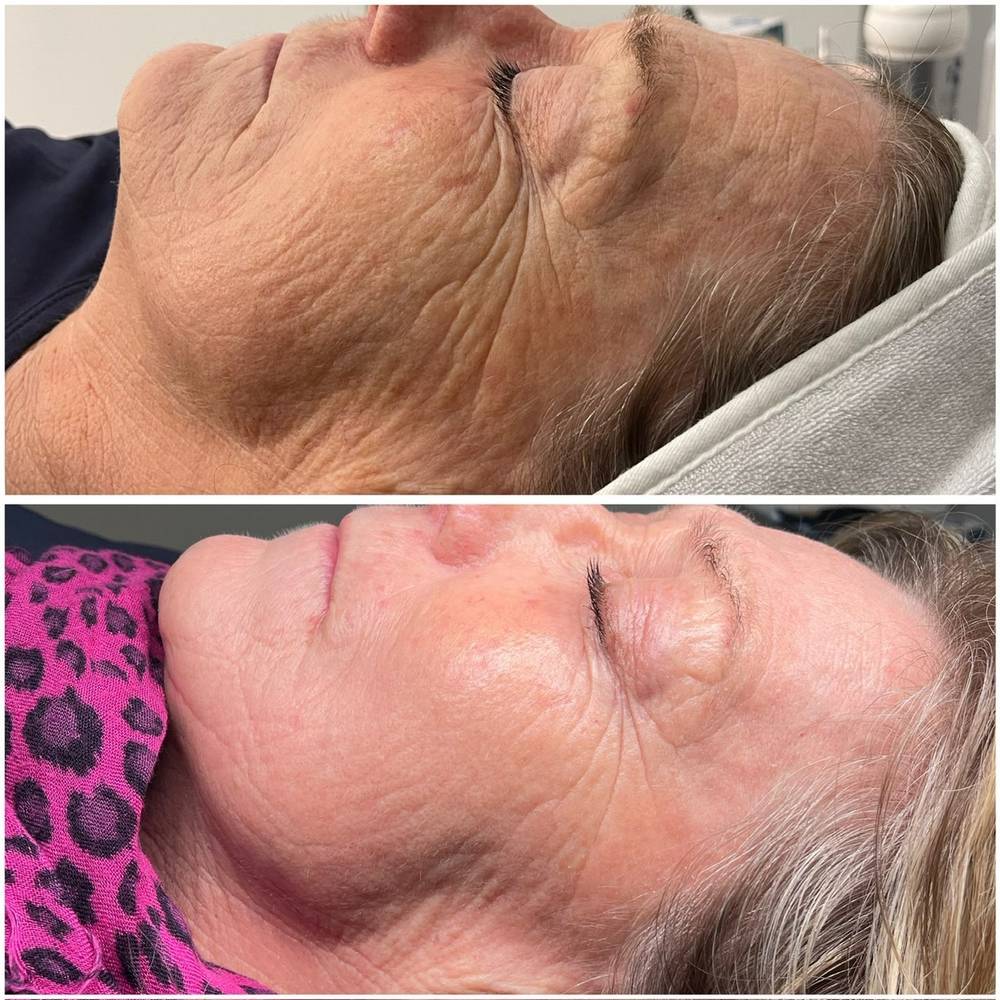Laserbehandling hos Ribelle Clinic